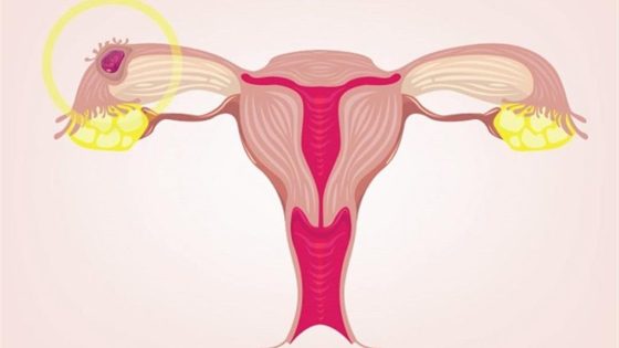 أعراض بطانة الرحم المهاجرة‏ وطرق علاجها