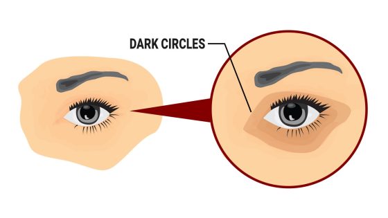 الهالات السوداء تحت العين: أسبابها وطرق علاجها