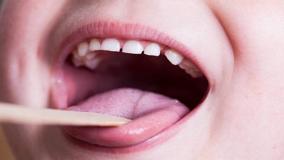 A close up on a wide open child's throat, being looked at