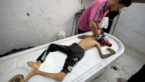الجوع يقتل أهل غزة والمساعدات تتحول إلى فخ مميت